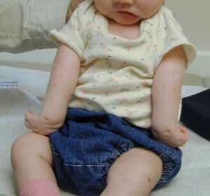 erb's palsy birth defect