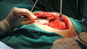 wrongful death at the operating table